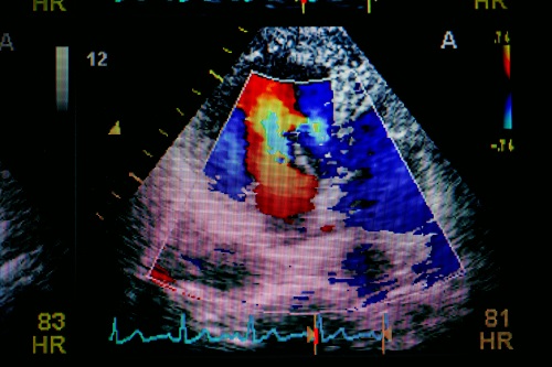 心臟超聲波