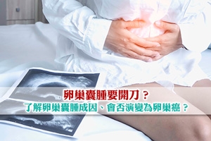 卵巢囊腫要開刀？了解卵巢囊腫成因 醫生解構演變卵巢癌風險