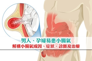 男人孕婦易患小腸氣 醫生解構小腸氣成因、症狀、診斷及治療